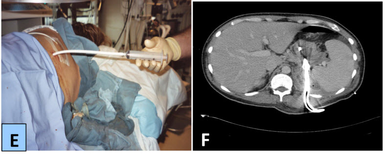 Figure 1: E, placement of the Malecot drain. F, follow-up CT scan demonstrating marked radiographic improvement at 1 month.