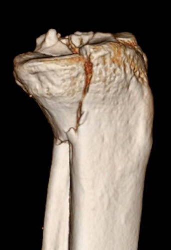 Figure B: Posteromedial tibial plateau fracture 3D CT scan