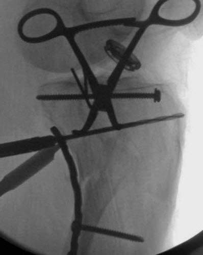 Figure C: placement of antiglide plate via Lobenhoffer approach