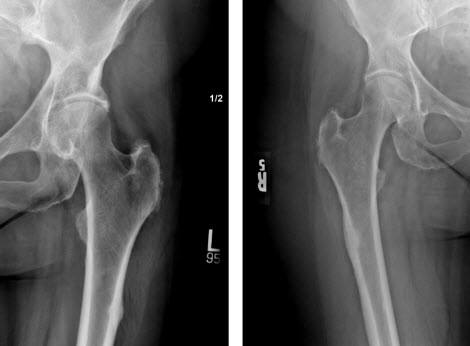 xray of left and right femurs