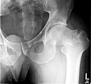 xray image of hip joint fracture