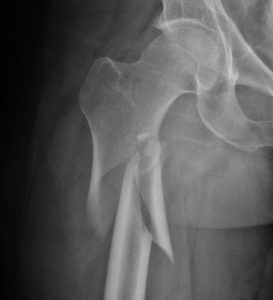 x-ray image of hip fracture