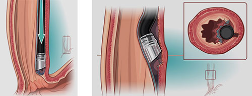 Per-oral Endoscopic Myotomy (POEM): Figure 1: Sub-mucosal tunnel creation extending towards the GE junction. Figure 2: Circular muscle fibers division maintaining intact longitudinal fibers beneath.