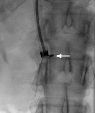 Technique for Removal of Embedded Inferior Vena Cava (IVC)