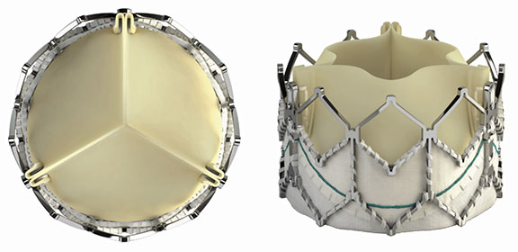 SAPIEN-XT-Valves的图像。左图:view of SAPIEN-XT-Valve. Pictured Right: Front view of SAPIEN-XT-Valve.