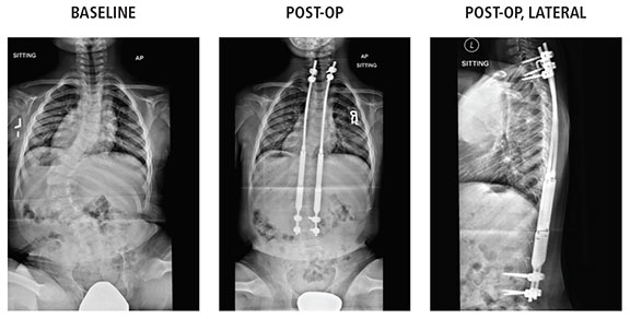 Figure: xrays of Baseline, Post-Op, and Post-Op Lateral images: