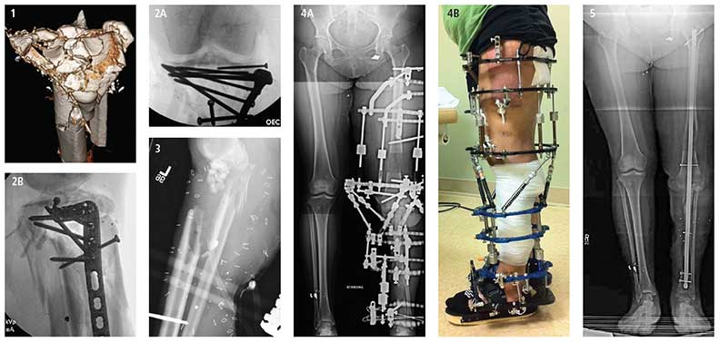 Photos and xrays of a complex limb reconstruction. FIGURE 1: Patient is a healthy female; mother of two. Three-dimensional CT scan shows highly comminuted traumatic injury to left proximal tibia. FIGURES 2A and B: Following multiple debridements, an attempt was made to reconstruct the proximal tibia and close the wound. FIGURE 3: Massive post-operative infection led to removal of all infected hardware, soft tissue and bone; bone defects totaled 11 centimeters. Antibiotic beads were placed into the wound area. FIGURES 4 and B: The Ilizarov technique and Taylor spatial frame were used for six months to heal the bone defects; the left knee joint was fused, resulting in a non-bending knee. FIGURE 5: An intermedullary nail was passed down through the bone for the final stage of bone-defect healing. The patient has recovered well with no pain, no use of ambulatory aids, and was able to resume most activities of daily living, including driving. Stair climbing and certain sitting situations remain a challenge.