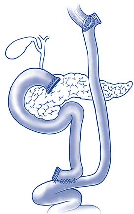 Roux-Y reconstruction with esophagojejunostomy. ©Steinemann et. al.; licensee BioMed Central Ltd. 2011.