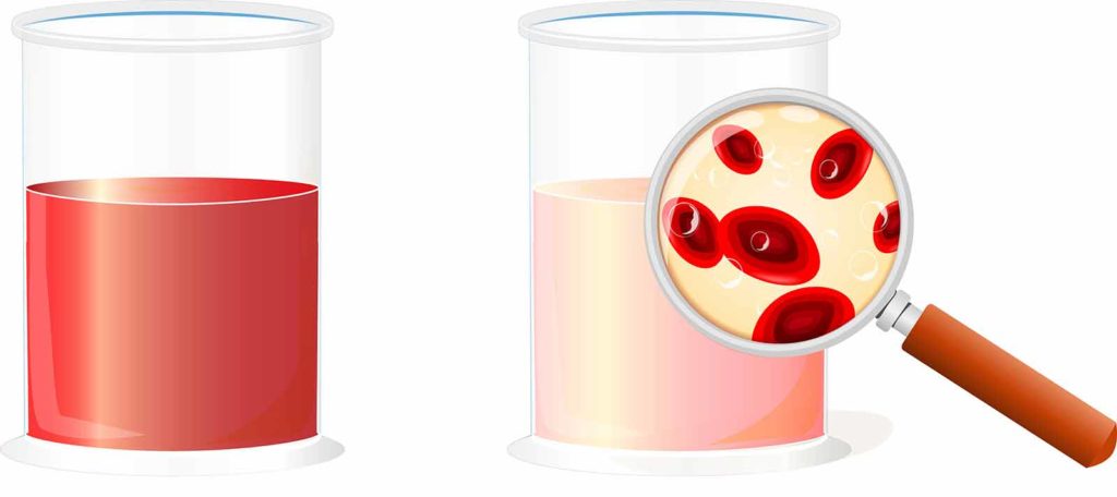 The image shows two beakers. The beaker on the left shows a urine specimen with visible (macroscopic) blood. The beaker on the right shows urine with microscopic blood not visible to the naked eye. The study seeks to evaluate patients with both types of blood in urine to determine the value of a biomarker in the evaluation.
