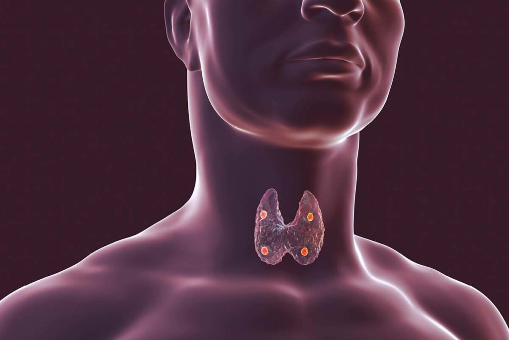 The image shows the thyroid gland and the four parathyroid glands, which are situated behind the thyroid gland. Credit: Getty Images