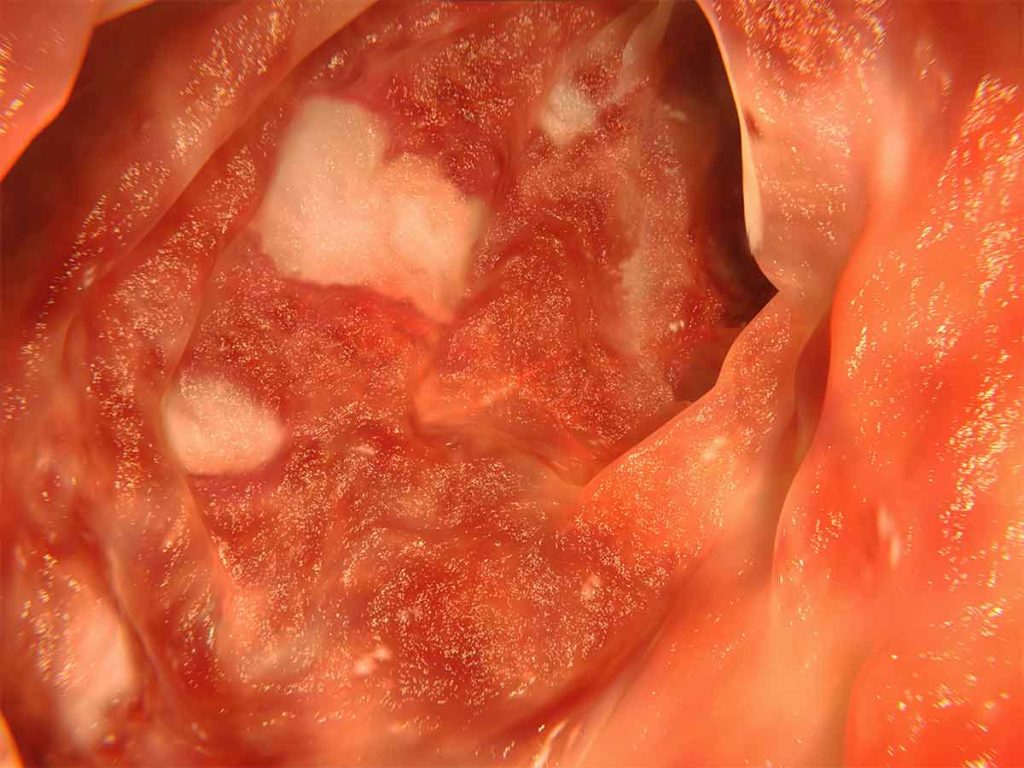 Artwork showing an endoscopic image of the colon affected by ulcerative colitis.