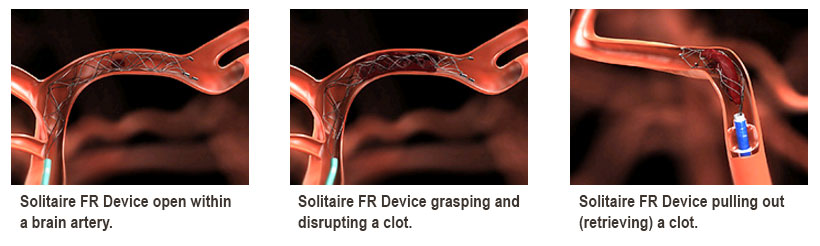 Images of Solitaire FR Device during the clot retrieval process.