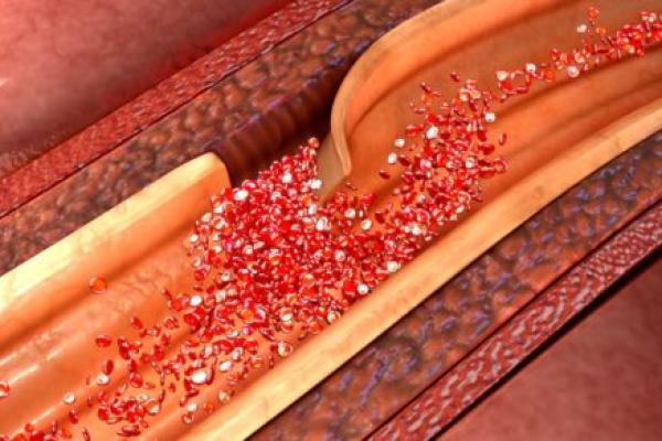 Illustration of an artery dissection.